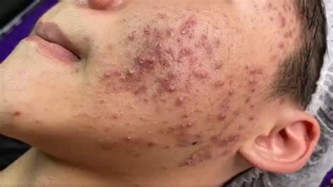 newest pimple pops. . Sac dep spa 2022 may